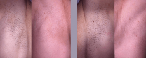 Laser-Haarentfernung 5