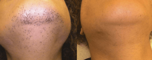 Laser-Haarentfernung 4