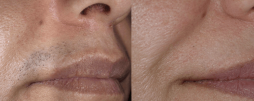 Laser-Haarentfernung 3