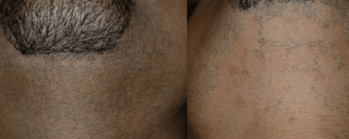 Laser-Haarentfernung 2