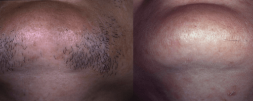 Laser-Haarentfernung 1