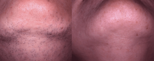 Laser-Haarentfernung 6